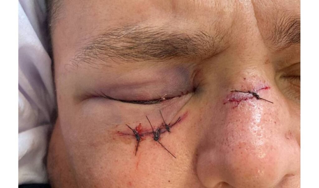 Vítima está internada e pode precisar passar por cirurgia por conta de uma lesão no olho. Caso aconteceu em uma padaria de
