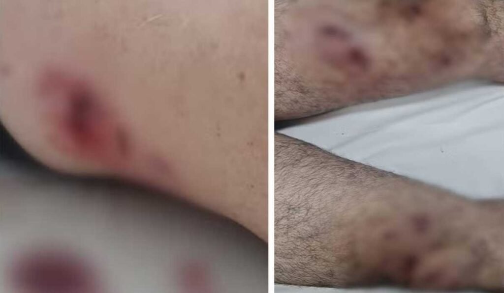 Servidor sofre fratura exposta e precisa passar por cirurgia após ser atacado por Pit bull